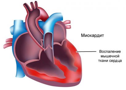 S-au identificat modificări difuze la nivelul miocardului